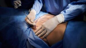 Lee más sobre el artículo Cirugías plásticas en República Dominicana: la búsqueda de belleza que puede terminar en tragedia